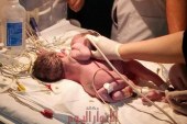 اول ولادة لتوأم ملتصق بمستشفى الاطفال الجامعى بالمنصورة